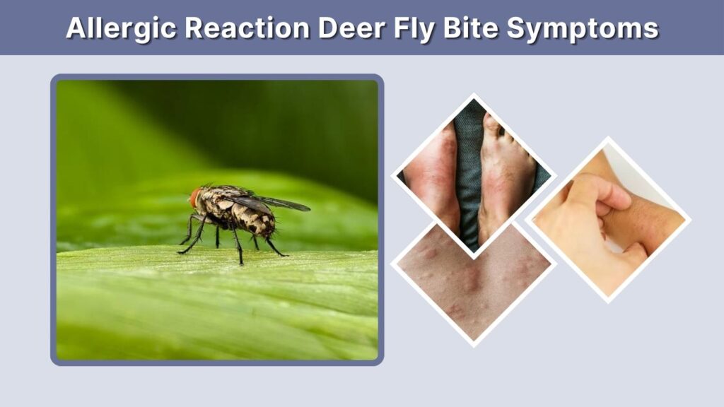 Allergic Reaction Deer Fly Bite Symptoms