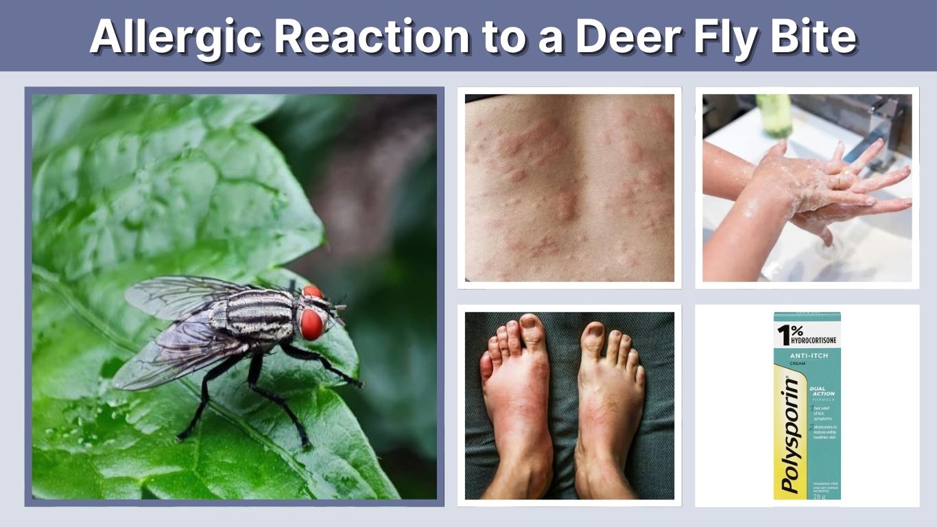 Allergic Reaction to a Deer Fly Bite: Signs and Treatment
