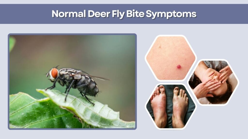 Normal Deer Fly Bite Symptoms