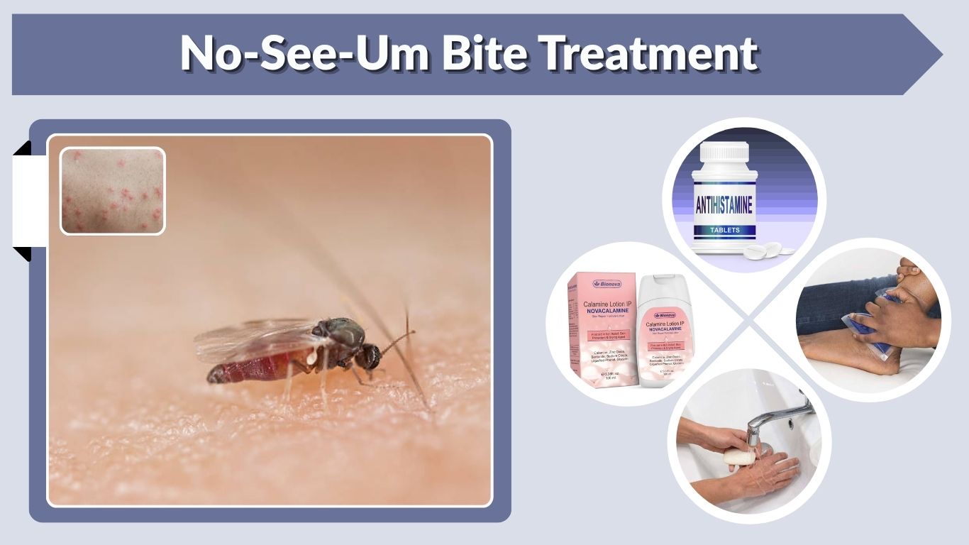 No-See-Um Bite Treatment: Fast Relief and Home Care