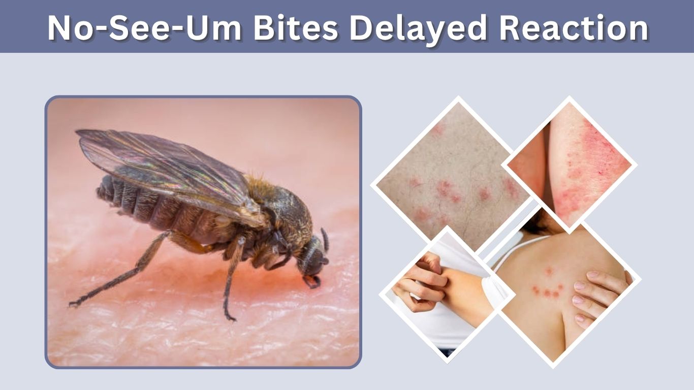 No-See-Um Bites Delayed Reaction: Symptoms and Treatment