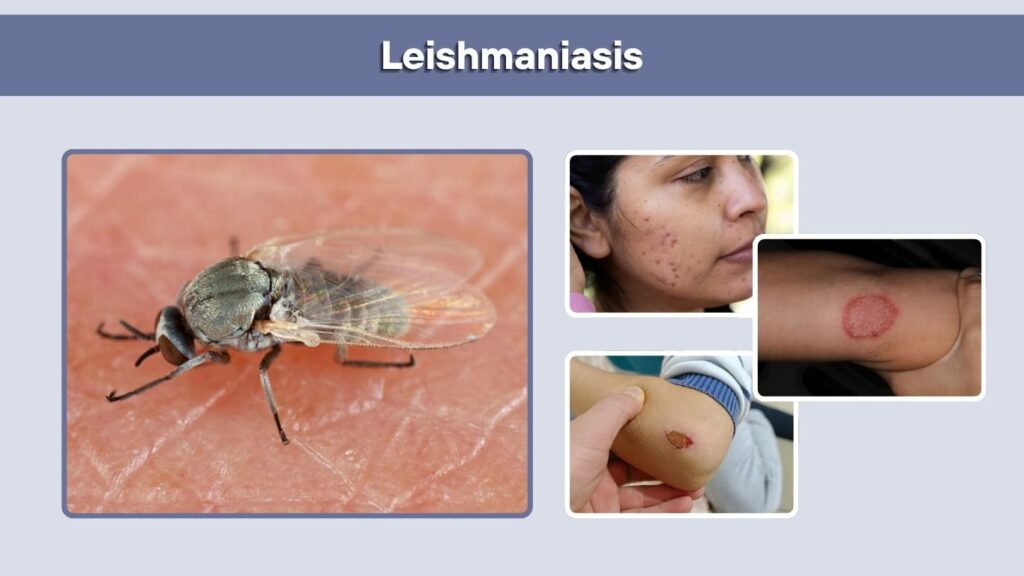 Leishmaniasis