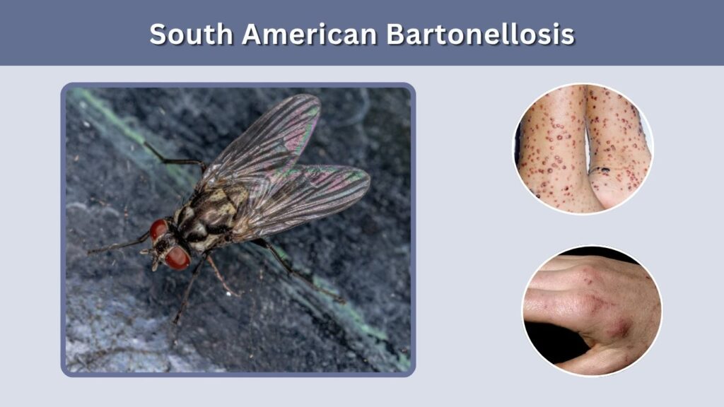 South American Bartonellosis