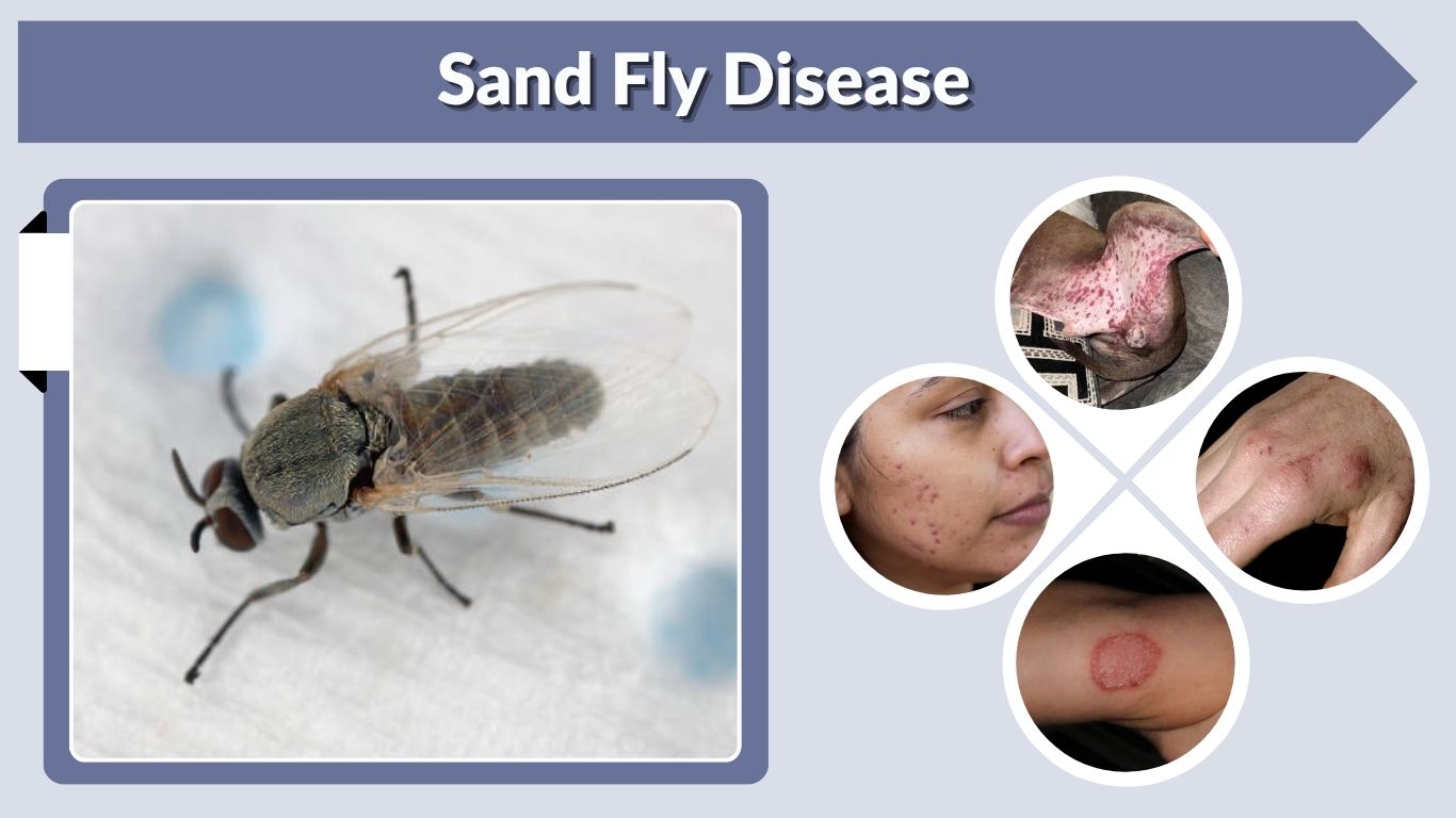 Sand Fly Disease: Symptoms, Types, Treatment and Prevention