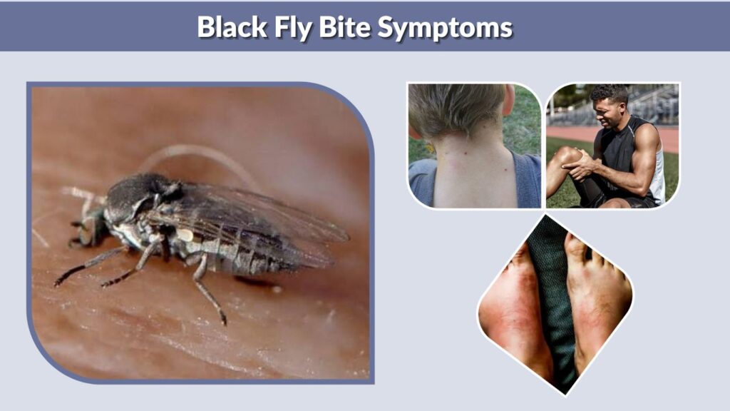 Black Fly Bite Symptoms