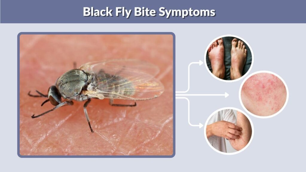 Black Fly Bite Symptoms